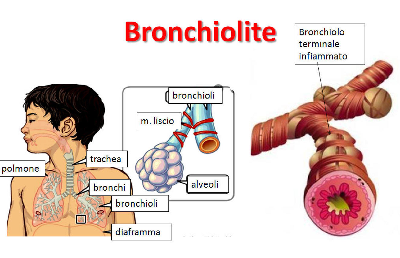 bronchiolite esempio