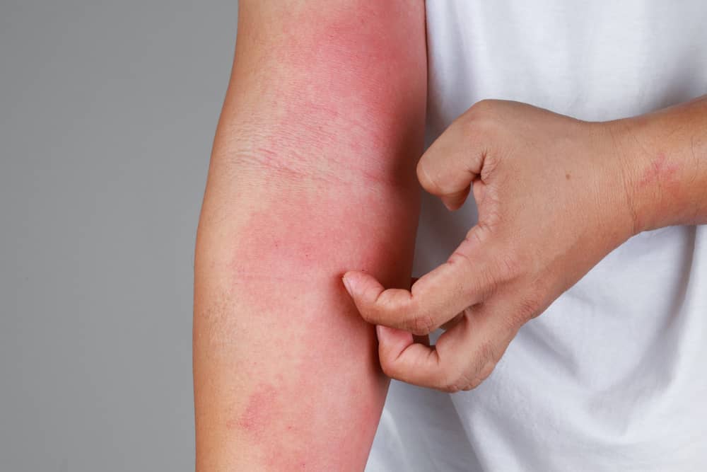 dermatitis por estres brazo