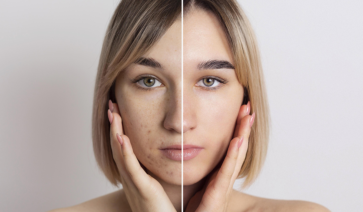 prima e dopo acne